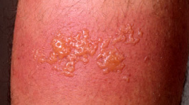 Burs of
                        second grade by tear gas water of criminal
                        Zurich bully police